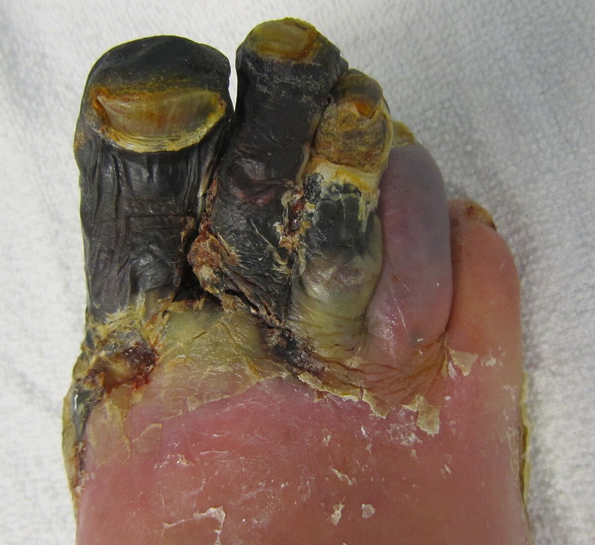 Gangrene